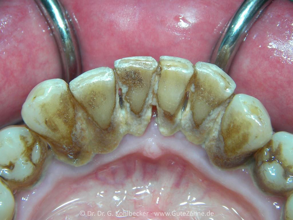 Was ist Zahnstein? Rhabarber und mehr… Gesunde Zähne